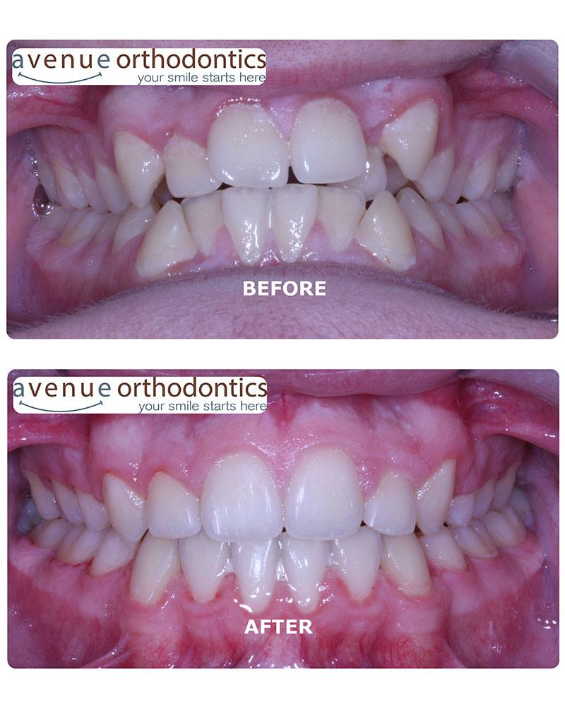 crossbite before & after