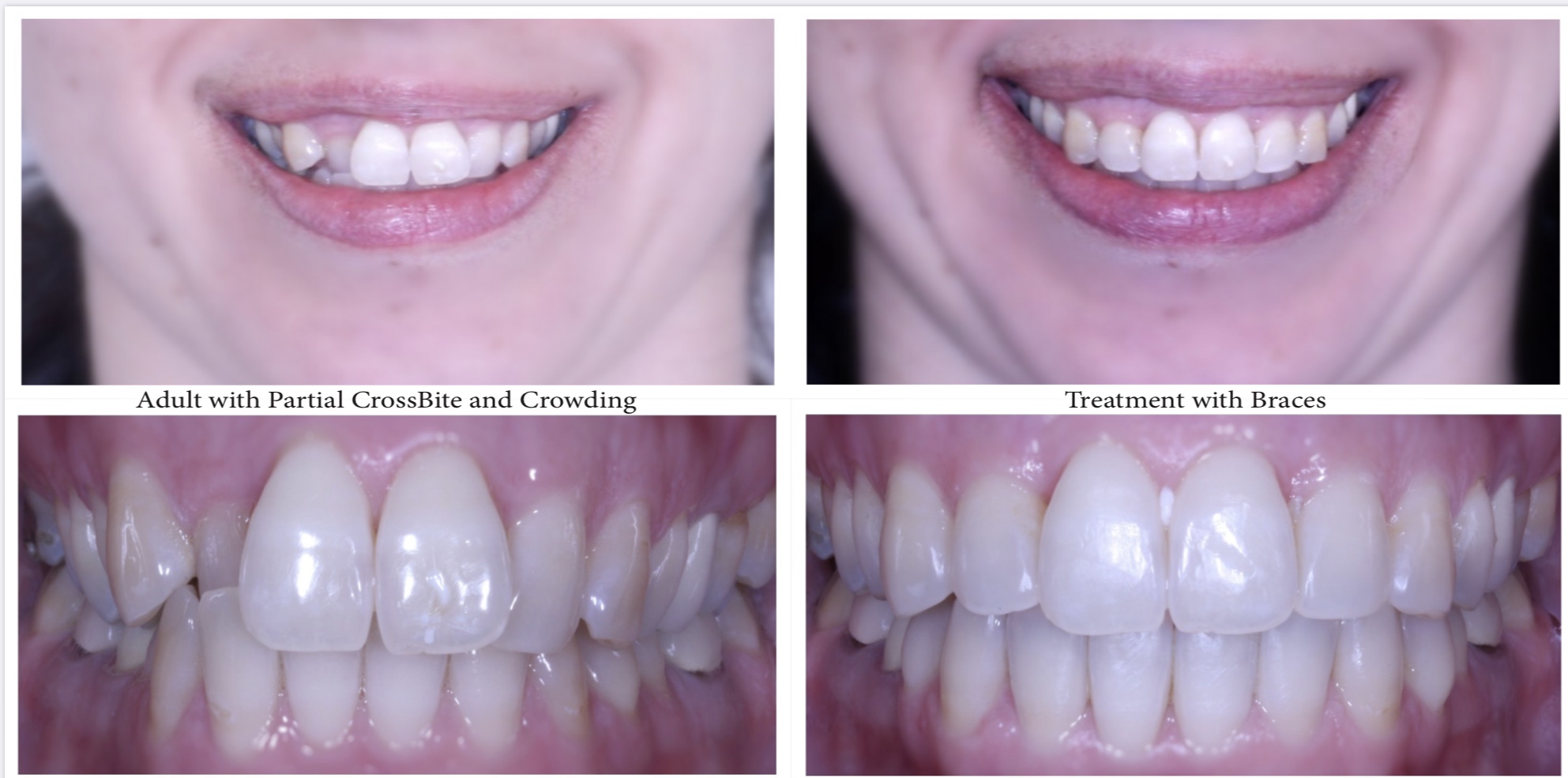 before and after braces adults